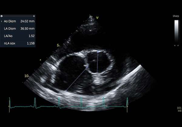 Measuring Left Atrial size